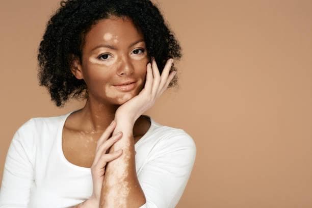 Vitiligo Hastalığı Nedir?