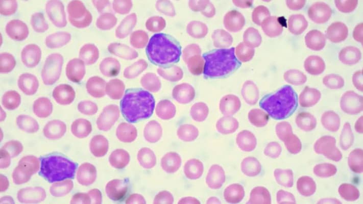 Bilim Adamları Lösemi İçin Çığır Açan Bir Tedavi Yöntemi Geliştirdi