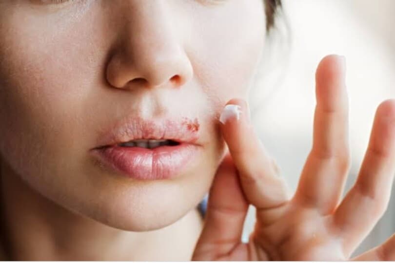 Eski Diş DNA'larında Bulunan Uçuk Virüsü Salgınlarla İlgili Yeni Bir Kapı Araladı