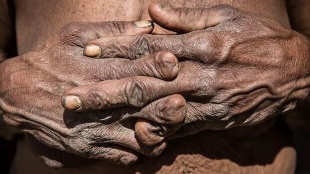 Papua ve Yeni Gine Dani Kabilesi Üyelerinin Yas İçin Parmaklarını Kesme Geleneği